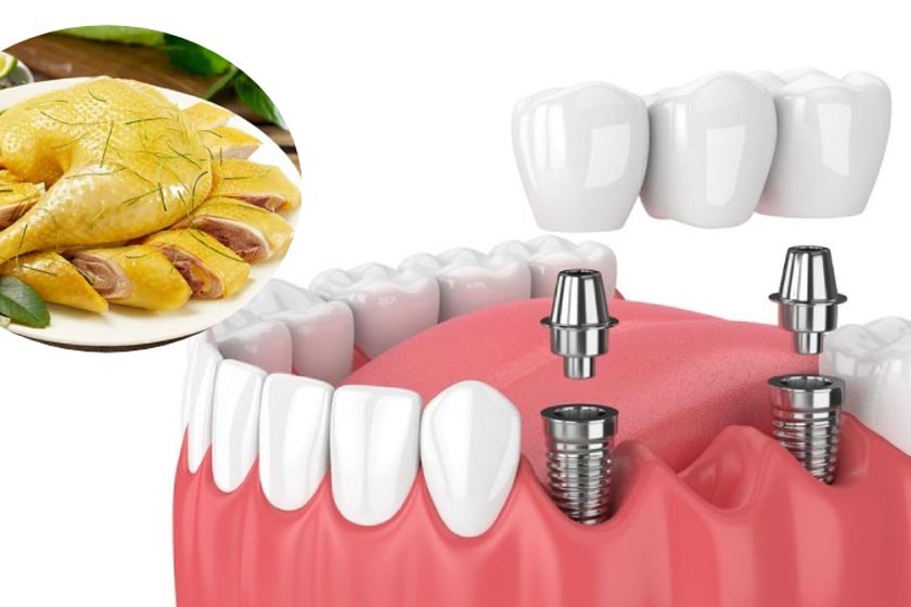 Trồng răng Implant có ăn được thịt gà không?