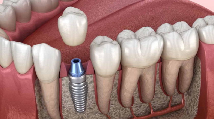 Trụ Implant được đặt độc lập vào khu vực răng đã mất, không gây xâm lấn răng bên cạnh