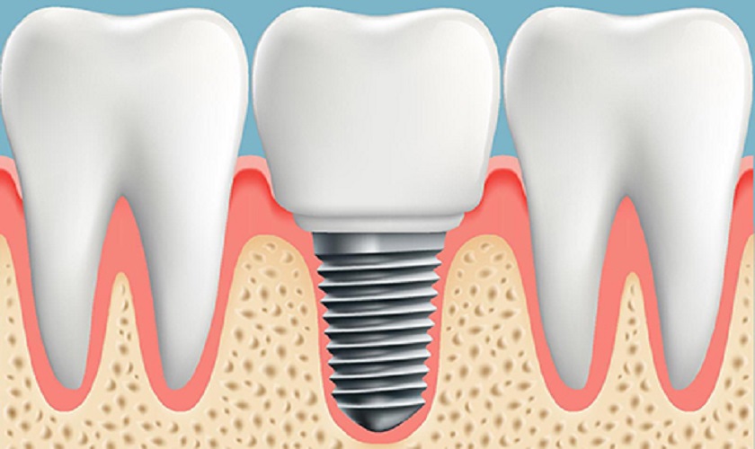 Giải đáp băn khoăn: Trồng răng Implant có gây dị ứng không?