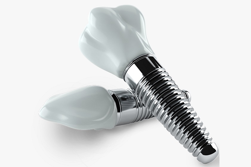 Chất lượng của trụ chân răng ảnh hưởng tới tuổi thọ của răng Implant