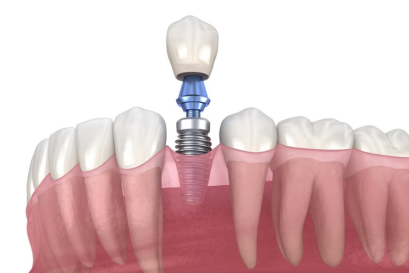 Trồng răng Implant là kỹ thuật có tuổi thọ cao nhất hiện nay