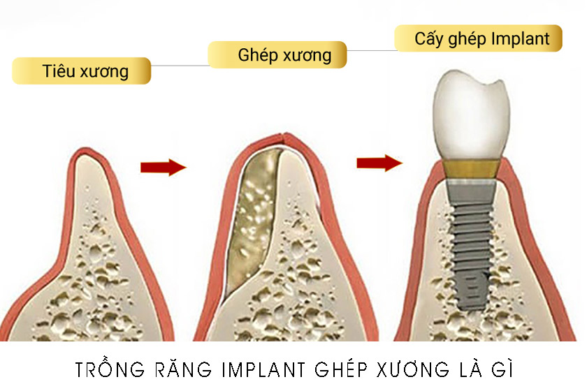 Trồng răng Implant ghép xương nha khoa là gi