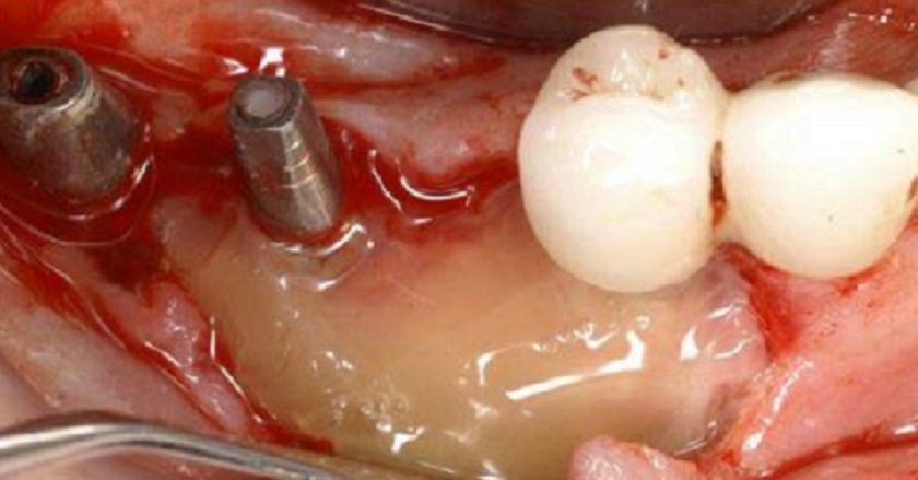 Chảy máu kéo dài là một biến chứng sau khi cắm Implant
