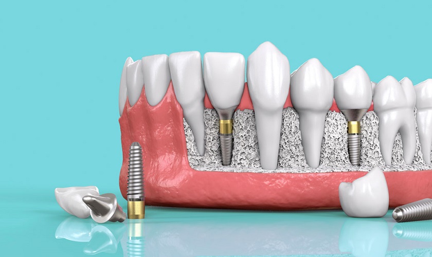 Nên lựa chọn trồng răng Implant cao cấp để đảm bảo hiệu quả và an toàn