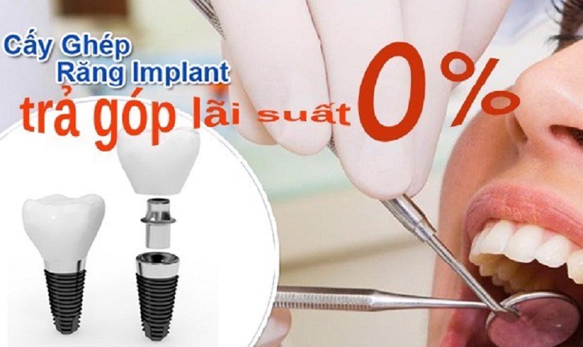 Dịch vụ làm răng Implant trả góp lãi suất 0% tại Nha khoa Nhân Tâm