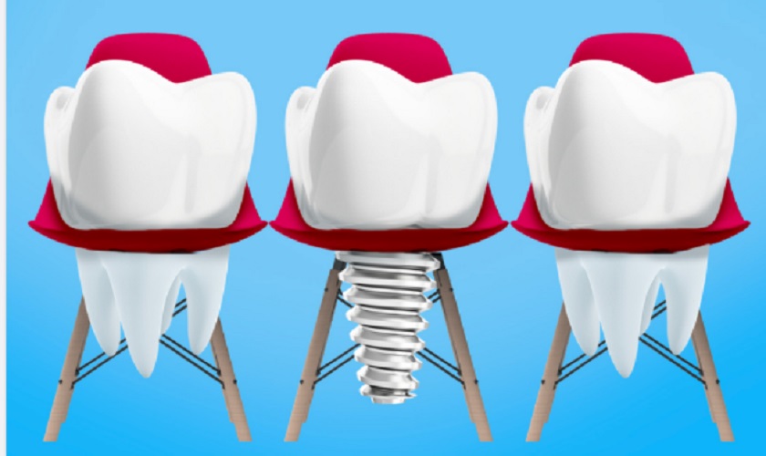 So với răng thật thì răng Implant chắc khỏe hơn nhiều