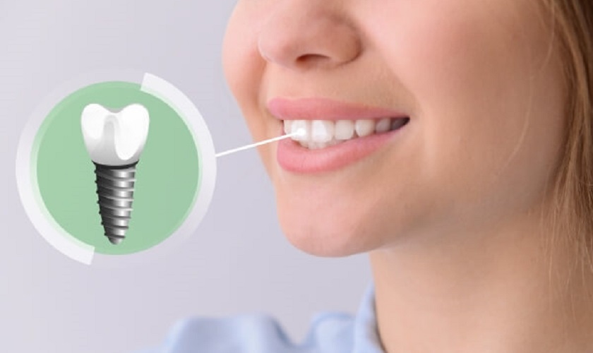 Tuổi thọ của răng Implant và những yếu tố ảnh hưởng