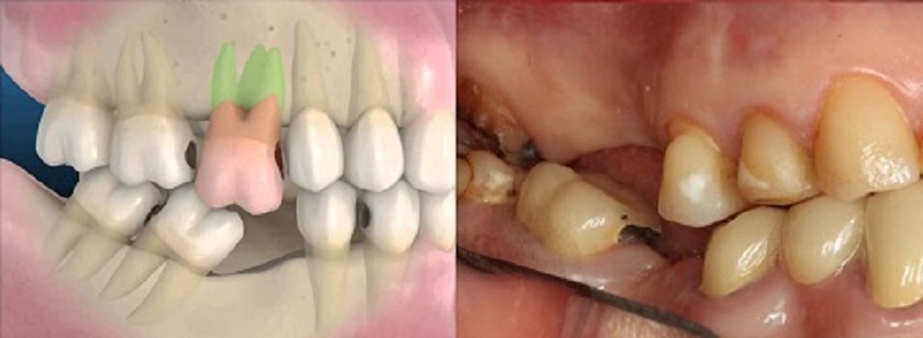 Xô lệch răng, sai khớp cắn do mất răng trong thời gian dài