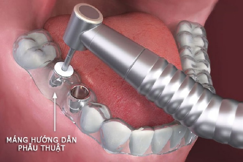 Kỹ thuật trồng răng Implant không rạch lợi với nhiều đặc điểm ưu việt