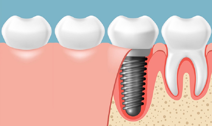 Trồng răng Implant không rạch lợi – Hạn chế đau nhức tối đa