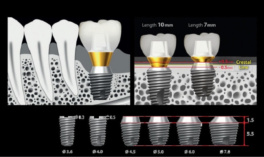 Trụ Implant Dentium Superline Mỹ