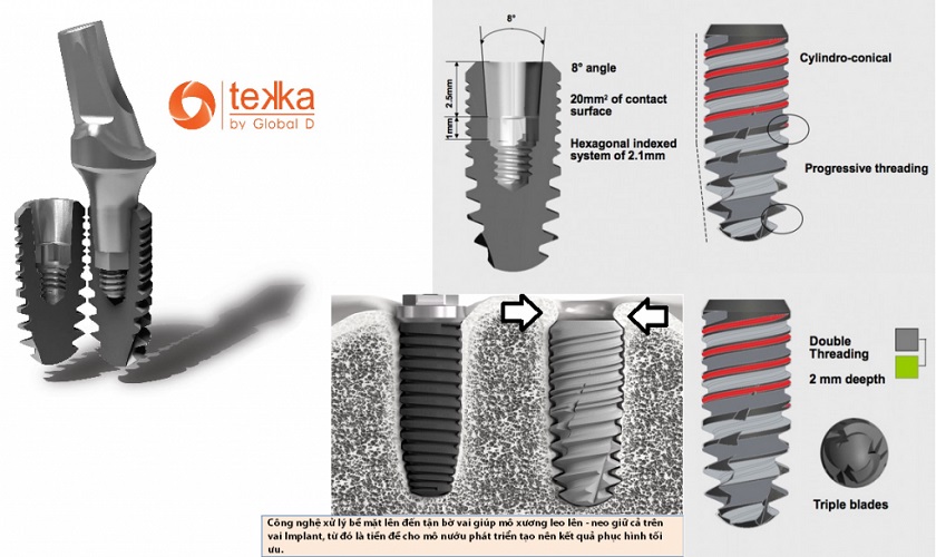 Trụ Implant Tekka cao cấp của Pháp