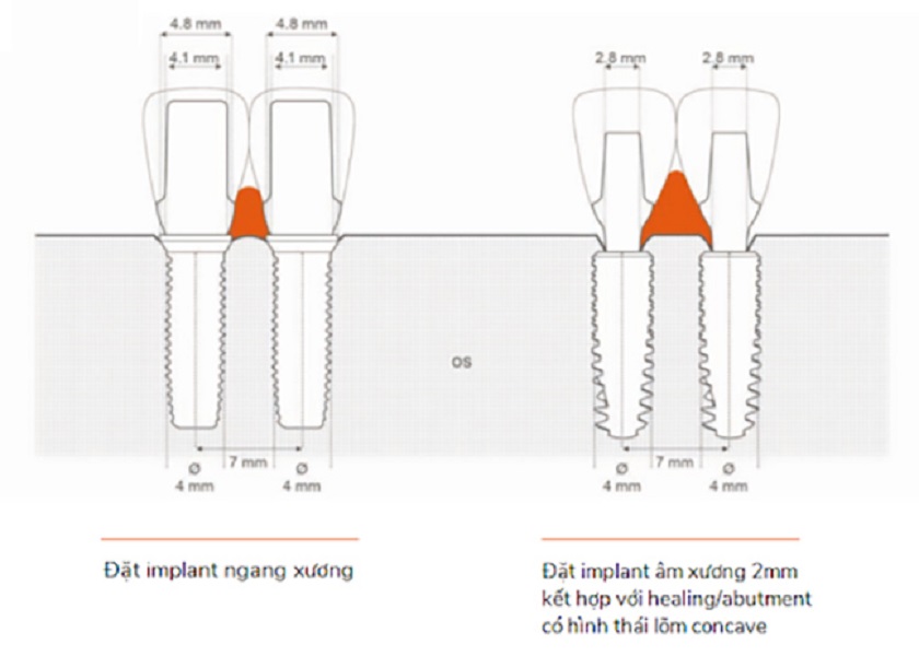 Hình ảnh minh họa trụ Implant khi đặt ở các vị trí khác nhau