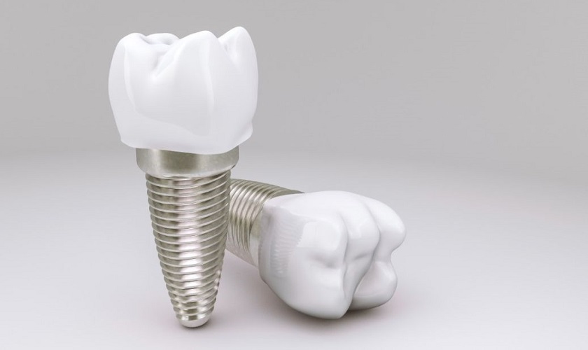 Trồng răng Implant loại nào tốt? Dựa vào đâu để quyết định?