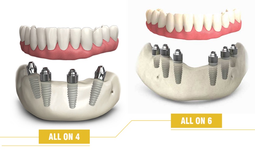 Kỹ thuật trồng răng Implant nguyên hàm All on 4 và All on 6