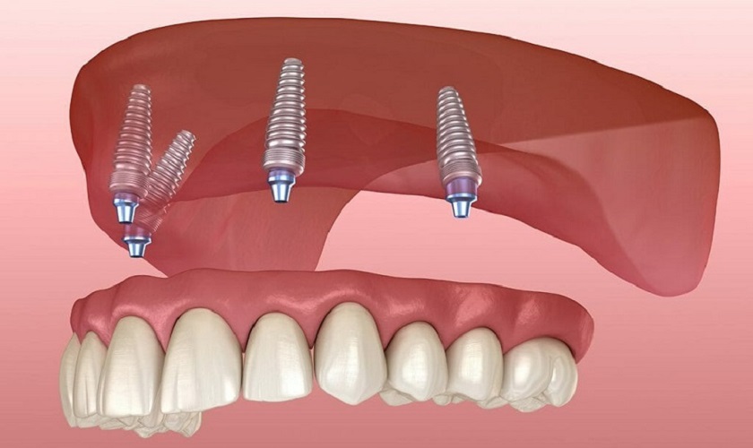 Trồng răng Implant nguyên hàm không gây đau nhức quá nhiều
