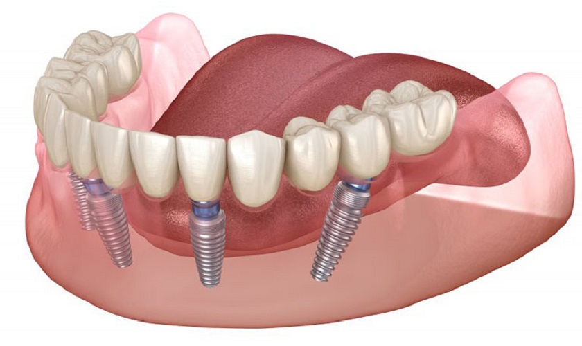 Trồng răng Implant nguyên hàm là gì? Giá bao nhiêu?