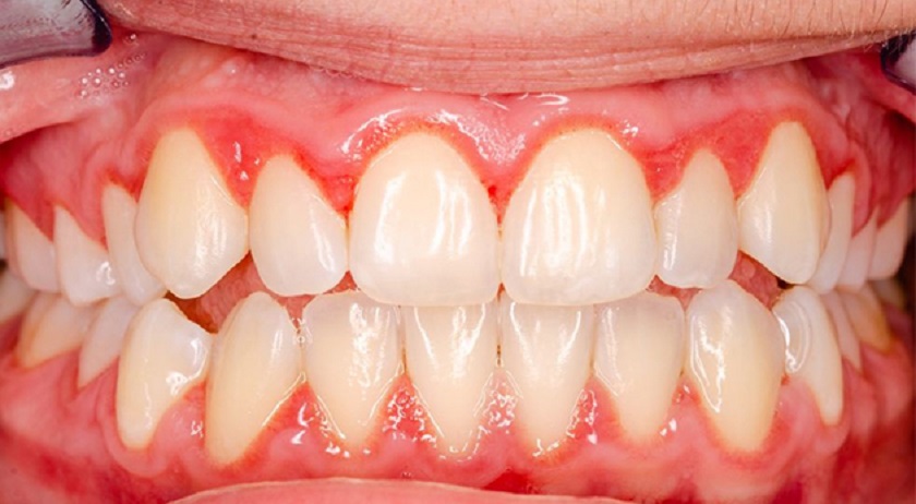 Viêm nướu nếu không được khắc phục sẽ dẫn đến trồng răng Implant thất bại
