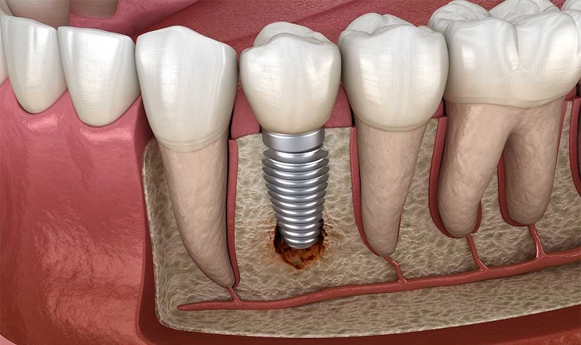 Trồng răng Implant thất bại do kỹ thuật không hiện đại