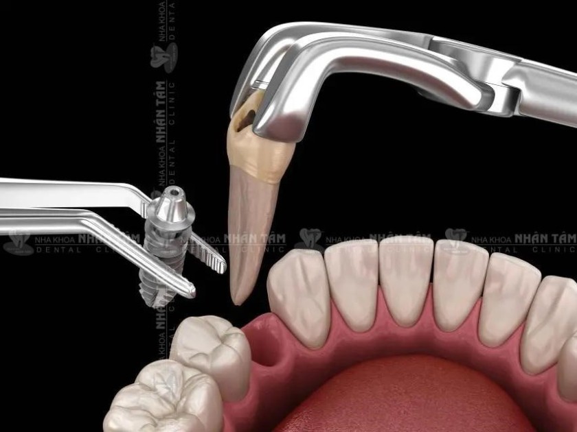 Kỹ thuật trồng răng Implant tức thì