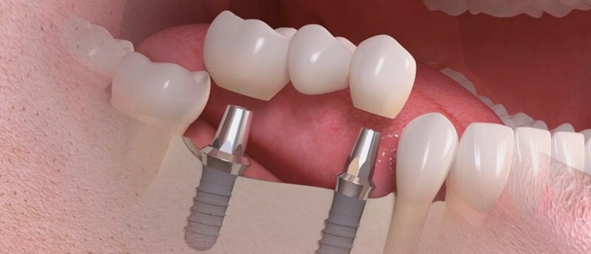 Quy trình trồng răng Implant như thế nào?