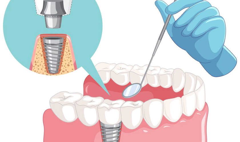 Bảng giá cấy răng Implant 2022