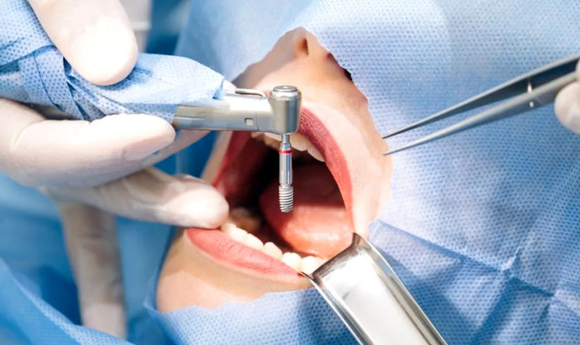 Các giai đoạn cắm răng Implant đạt chuẩn Nha khoa