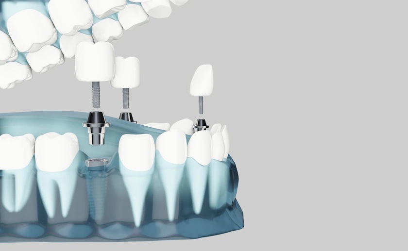 Phục hình răng sứ trên trụ Implant