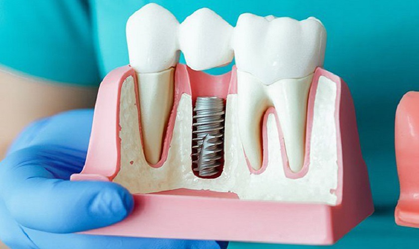 4 điều cần chú ý trước khi cấy răng Implant