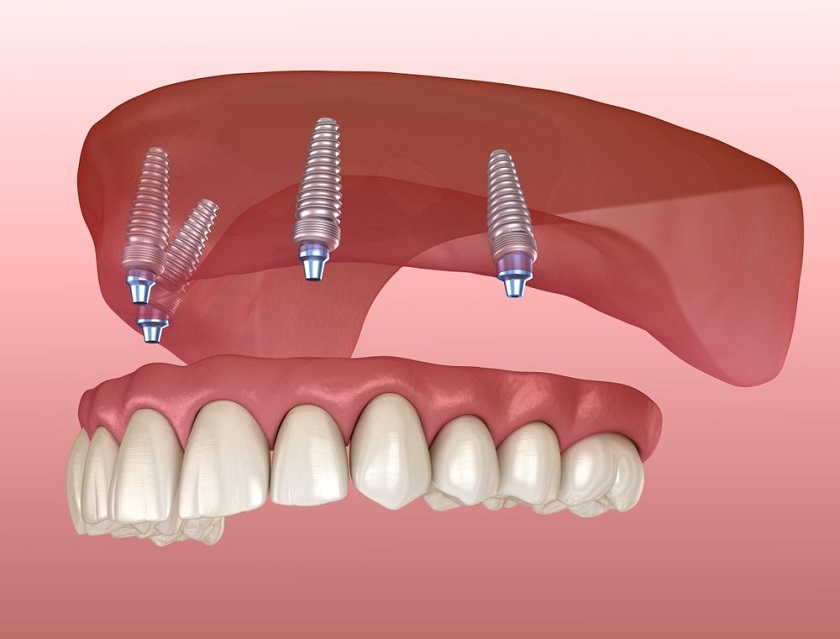 Sau cấy ghép implant cần tuân thủ chăm sóc răng miệng để tránh tình trạng viêm nhiễm