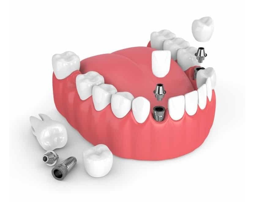 Trồng răng Implant giúp mang lại vẻ đẹp hoàn toàn tự nhiên cho răng