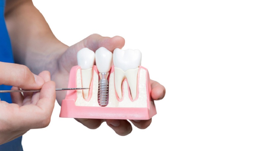 Bác sỹ nào nổi tiếng trồng răng Implant tại TPHCM?