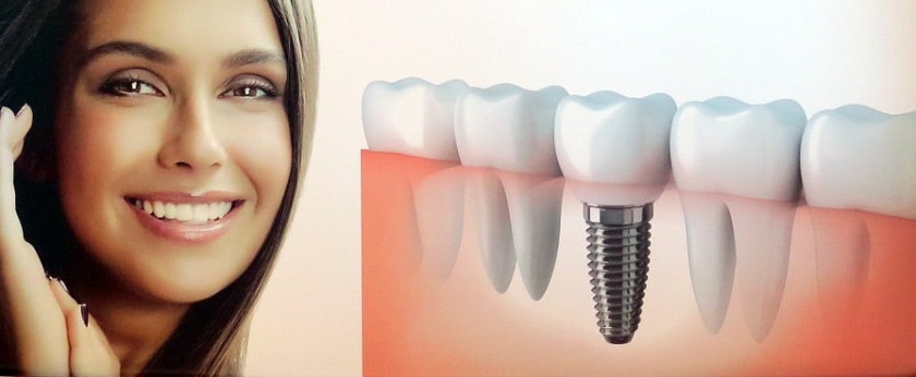 Cấy ghép Implant giúp đảm bảo các chức năng răng