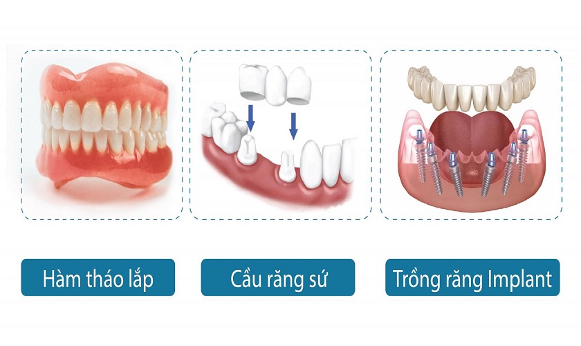 Bảng giá trồng răng chi tiết với các phương pháp trồng răng giả phổ biến