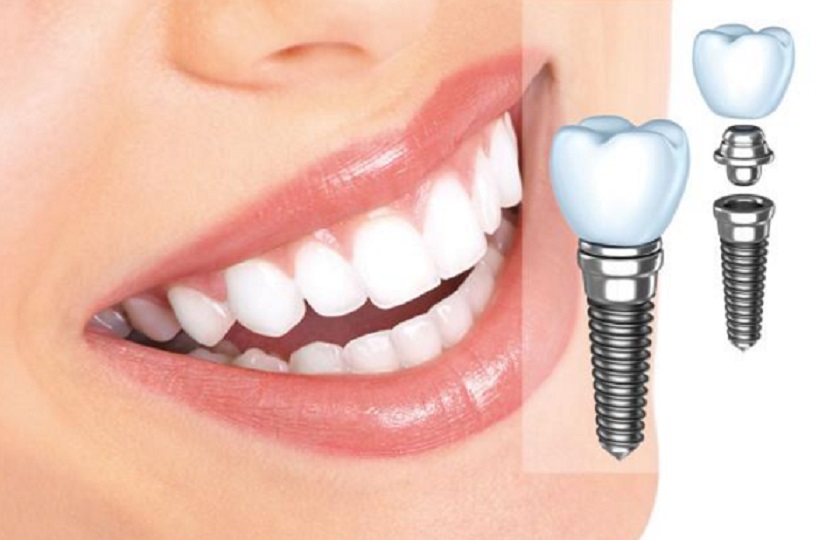 Trồng răng Implant đem lại nhiều lợi ích cho người sử dụng