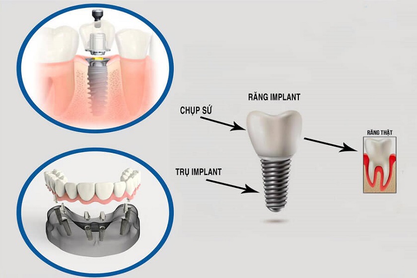 Răng Implant với cấu tạo tương tự như răng thật