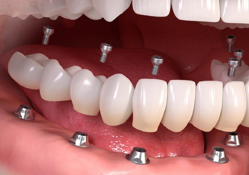 Báo giá trồng răng Implant sẽ có sự chênh lệch tùy vào nhiều yếu tố