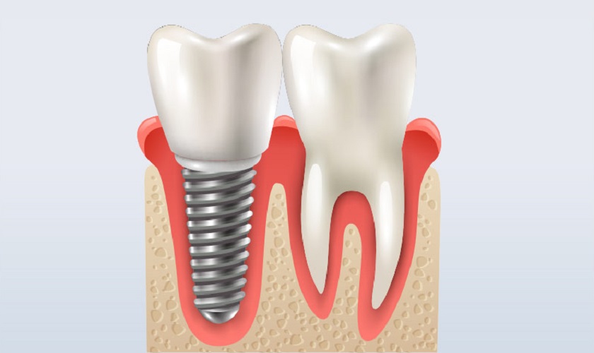 [Chi tiết] Báo giá dịch vụ trồng răng Implant mới nhất