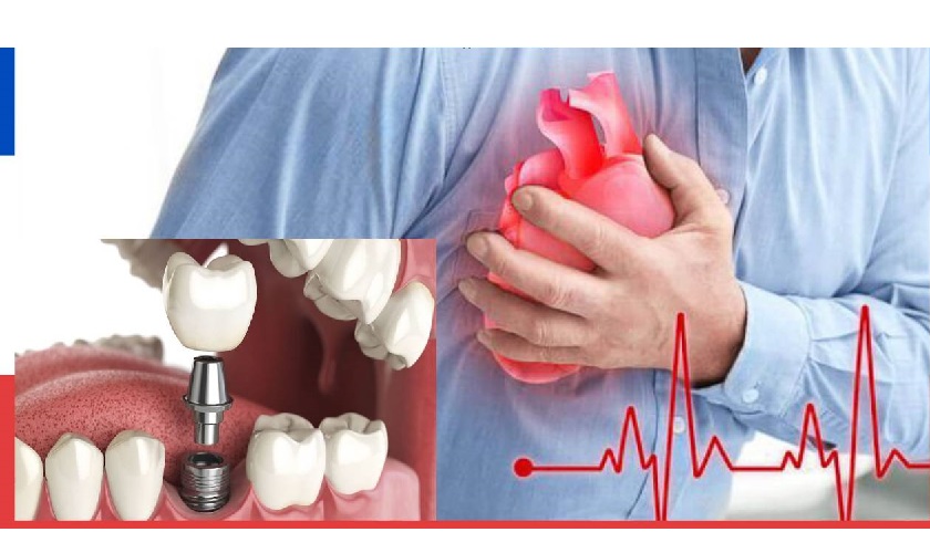Người bị bệnh tim mạch có trồng răng Implant được không?