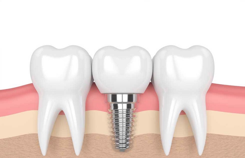 Chọn nha khoa có kinh nghiệm trồng răng Implant cho người bị loãng xương