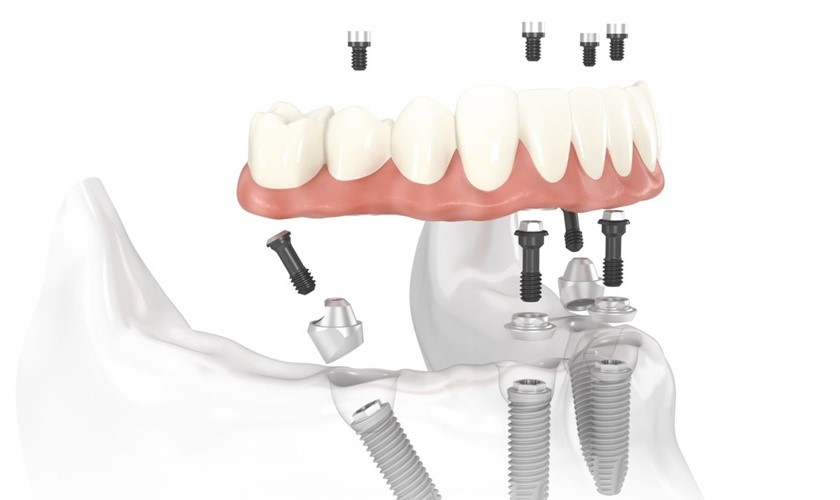 Phương pháp điều trị mất răng hiệu quả
