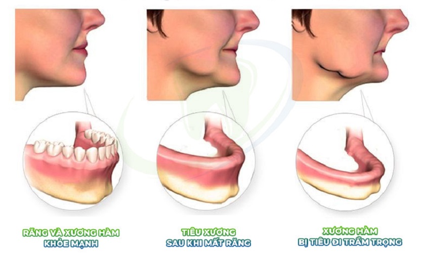 Bị móm do mất răng - Điều trị bằng phương pháp nào?