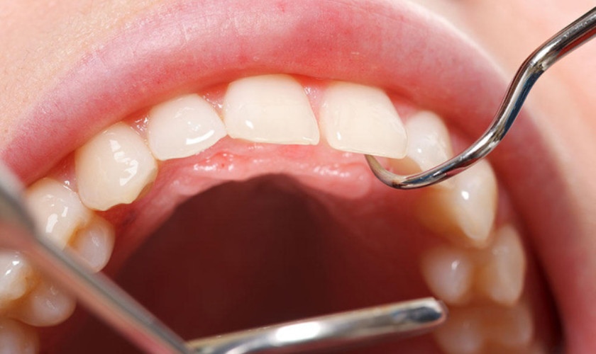 Bị sưng nướu răng và giải pháp điều trị chuẩn nha khoa 2024