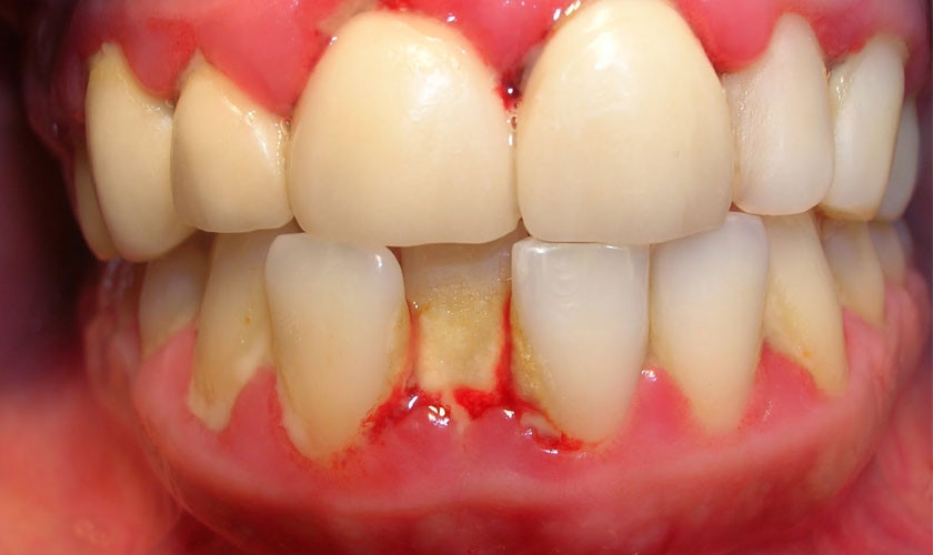 Bị viêm nướu răng là một trong những dấu hiệu của bệnh nha chu