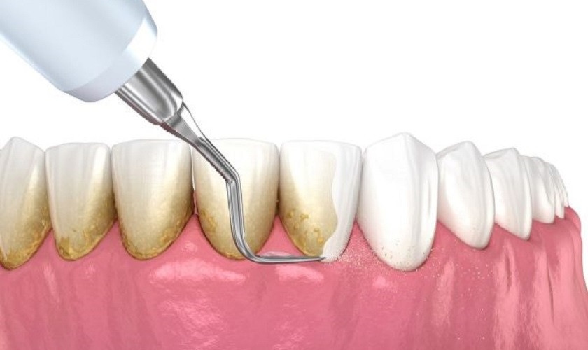 Lấy cao răng định kỳ là giải pháp chăm sóc răng miệng hiệu quả