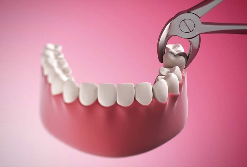 Nhổ bỏ răng khôn để ngăn ngừa tình trạng nhiễm trùng