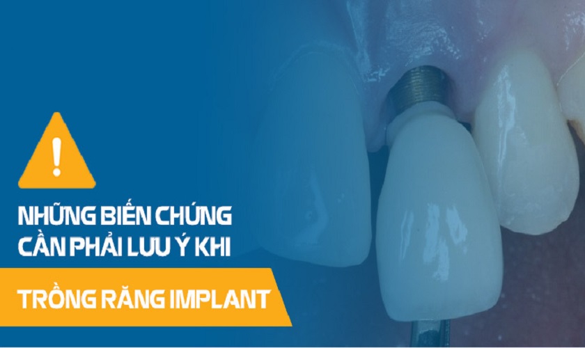 Biến chứng khi trồng răng Implant sai kỹ thuật