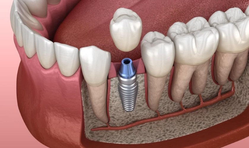 Phương pháp bọc răng sứ Implant