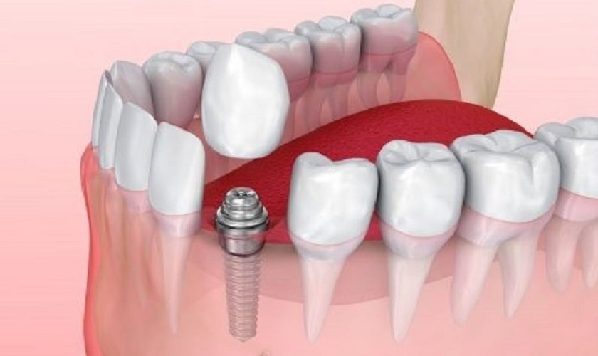 Gắn răng sứ lên trụ Implant