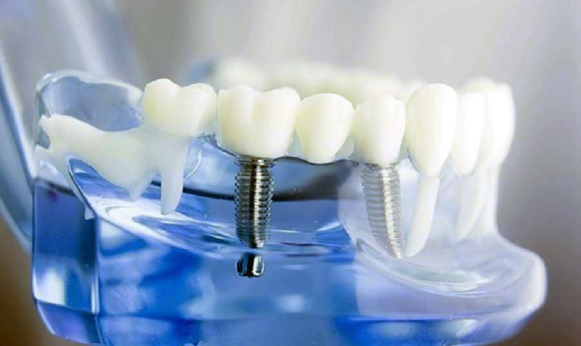 Tìm hiểu phương pháp phục hình răng bằng bọc răng sứ Implant
